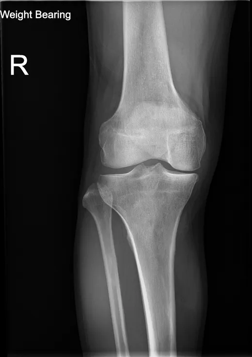 Radiografía de rodilla en carga, de pie, donde se valora el espacio articular