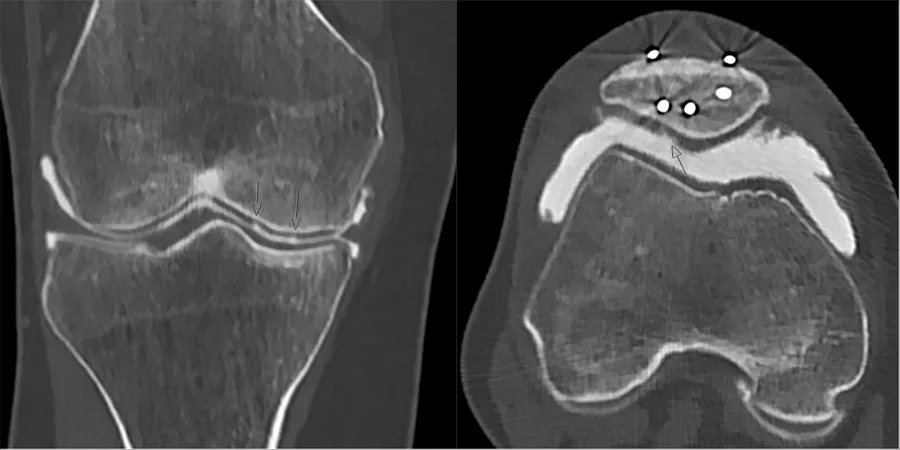 Artro-TC de rodilla: corte axial de la articulación femoropatelar con adelgazamiento del cartílago de la rótula