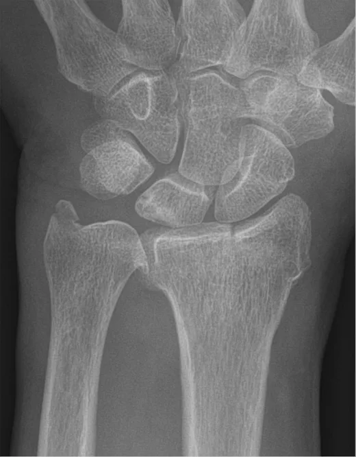 Magnetoterapia para la fractura de Chauffeur (estiloides radial)