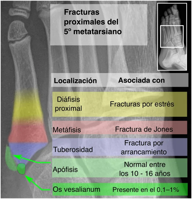 Magnetoterapia para la fractura del quinto metatarsiano