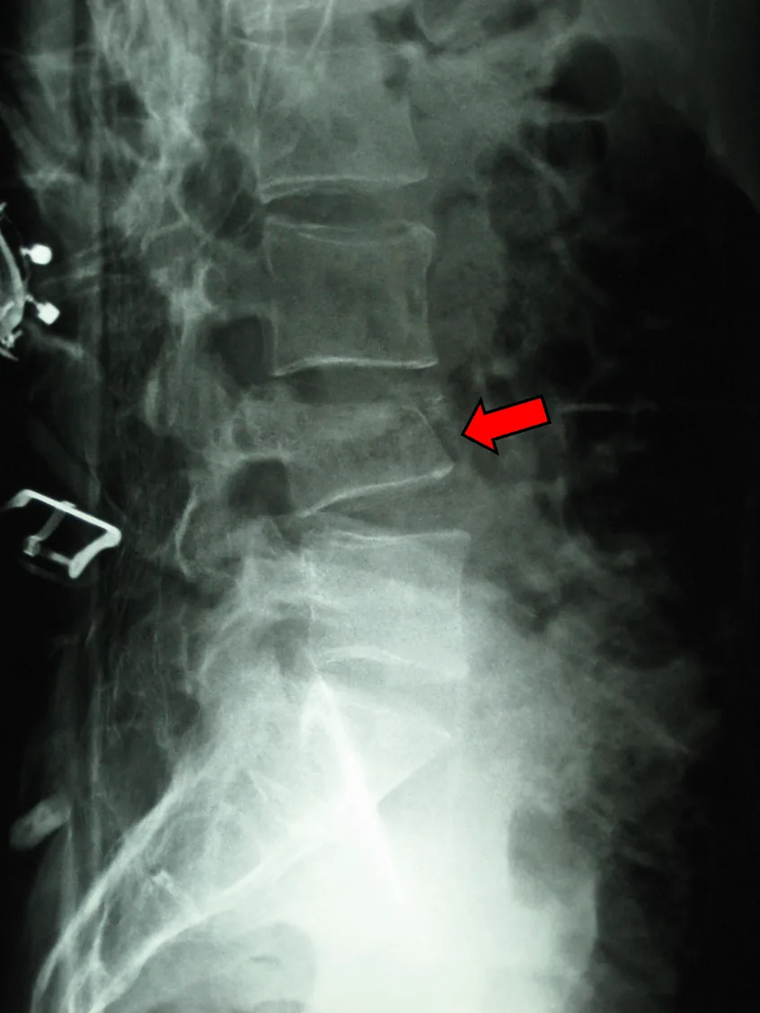 Fractura vertebral: tipos, plazos y recuperación