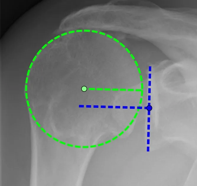 Radiografía de la articulación del hombro