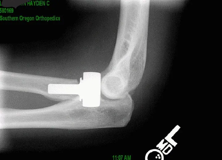 Magnetoterapia tras la cirugía de la cabeza del radio