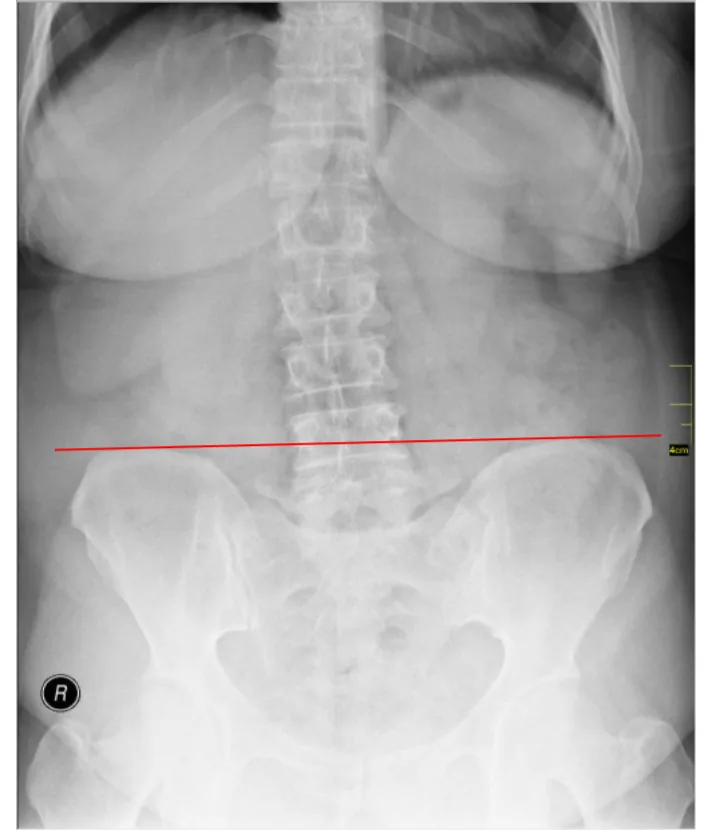 Radiografía de la columna lumbar