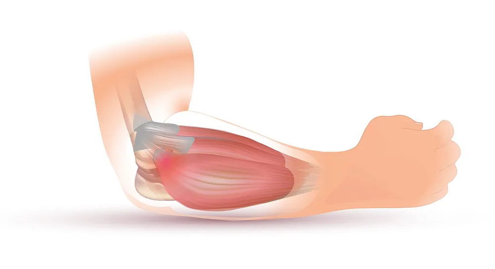 Ilustración anatómica del codo y la epicondilalgia lateral