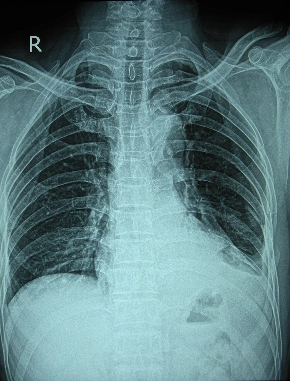 Radiografía de tórax con fractura de costillas