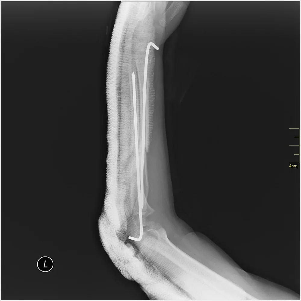 Radiografía de una fractura de cúbito en el antebrazo