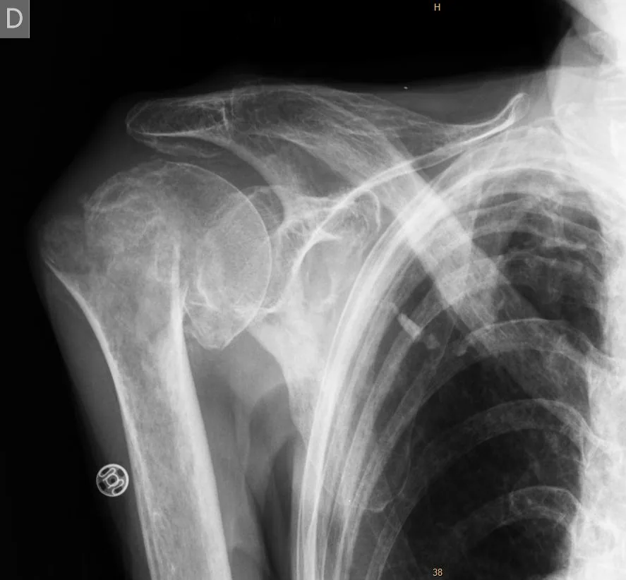 Radiografía de una fractura de húmero en el brazo