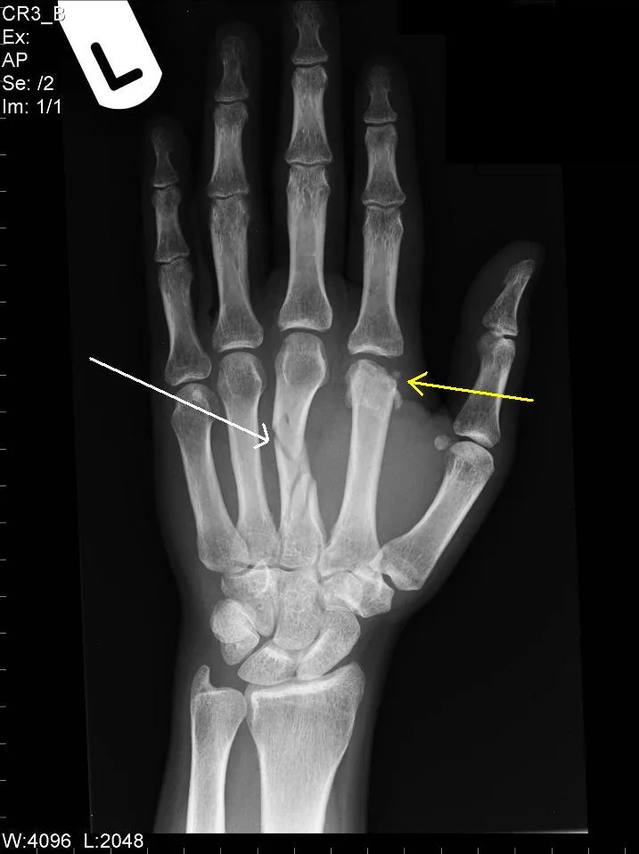 Radiografía de una fractura de metacarpiano en la mano
