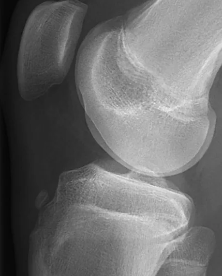 Radiografía de una fractura por avulsión