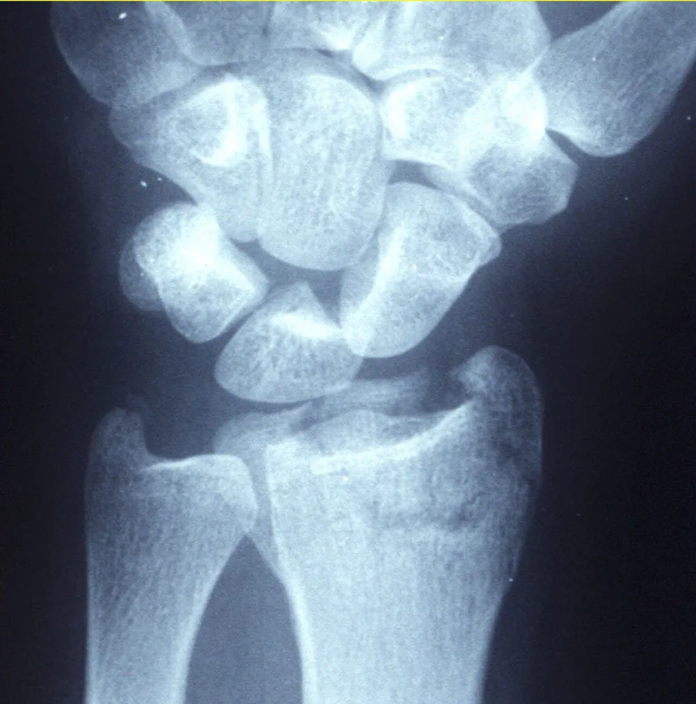 Radiografía de una fractura de radio distal (Colles) en la muñeca