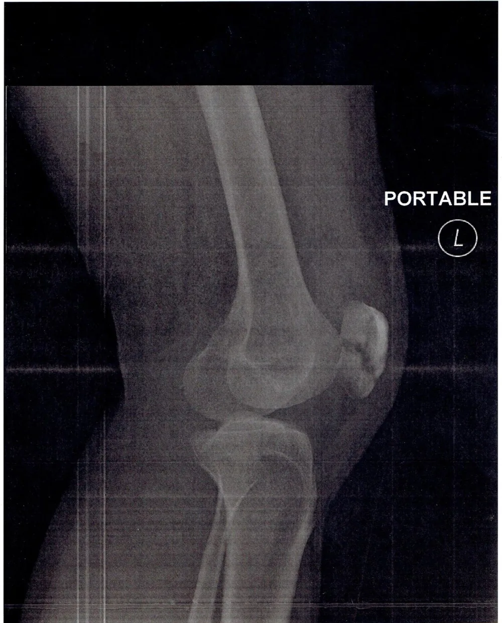 Radiografía de una fractura de rótula en la rodilla