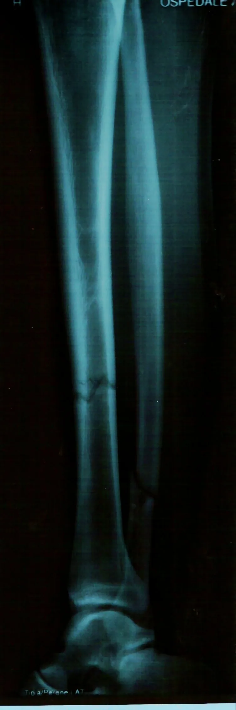 Radiografía de una fractura de tibia y peroné en la pierna