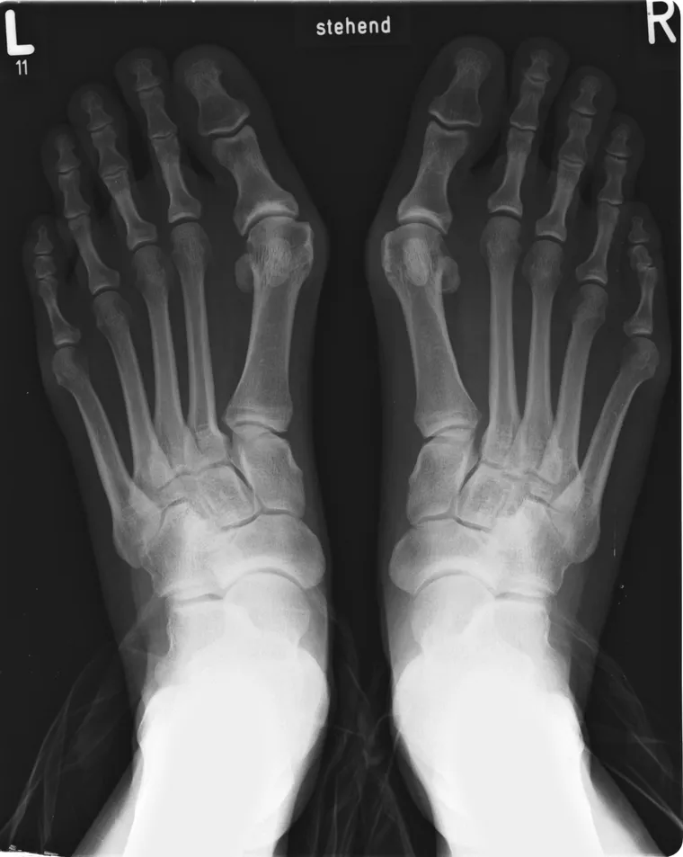 Magnetoterapia para hallux valgus (juanete)