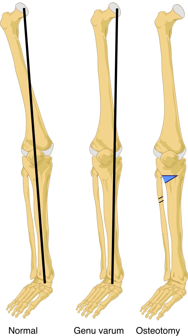 Magnetoterapia tras una osteotomía