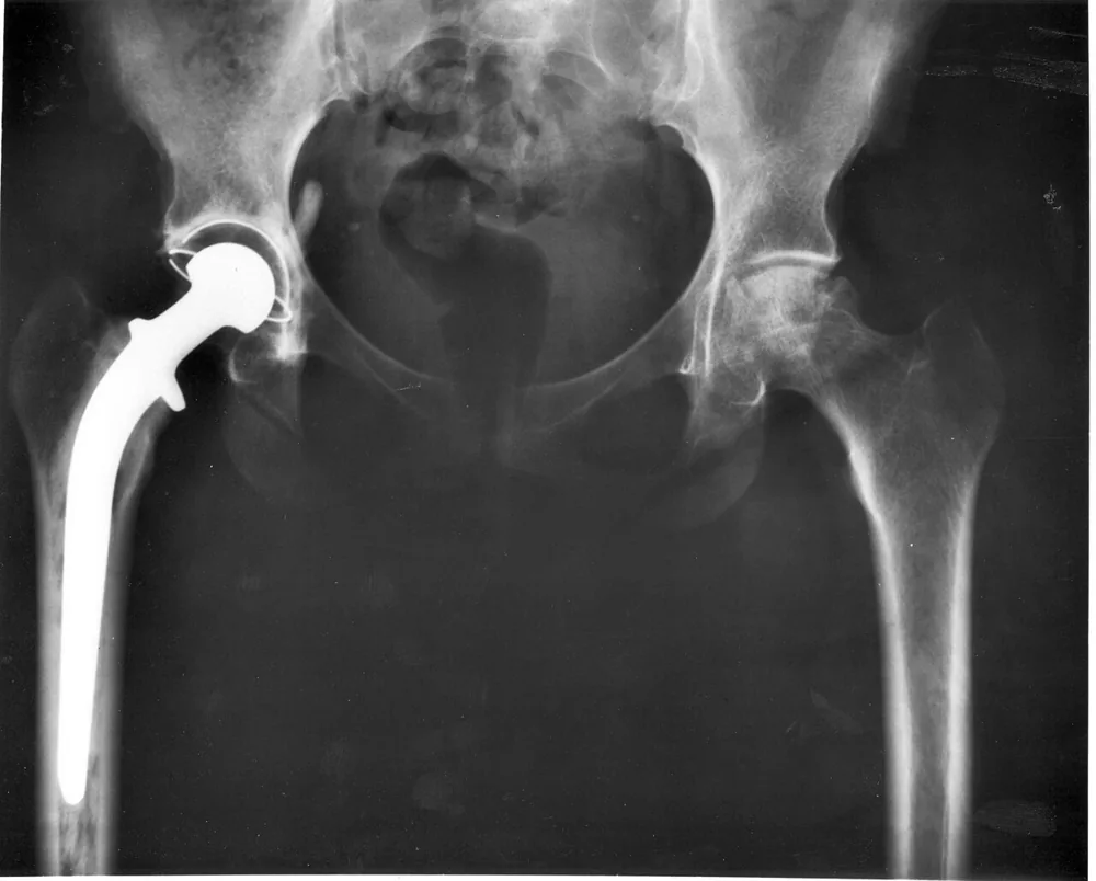 Radiografía de una prótesis total de cadera