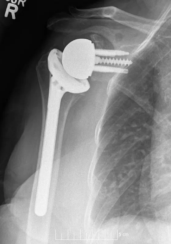 Magnetoterapia tras una prótesis de húmero