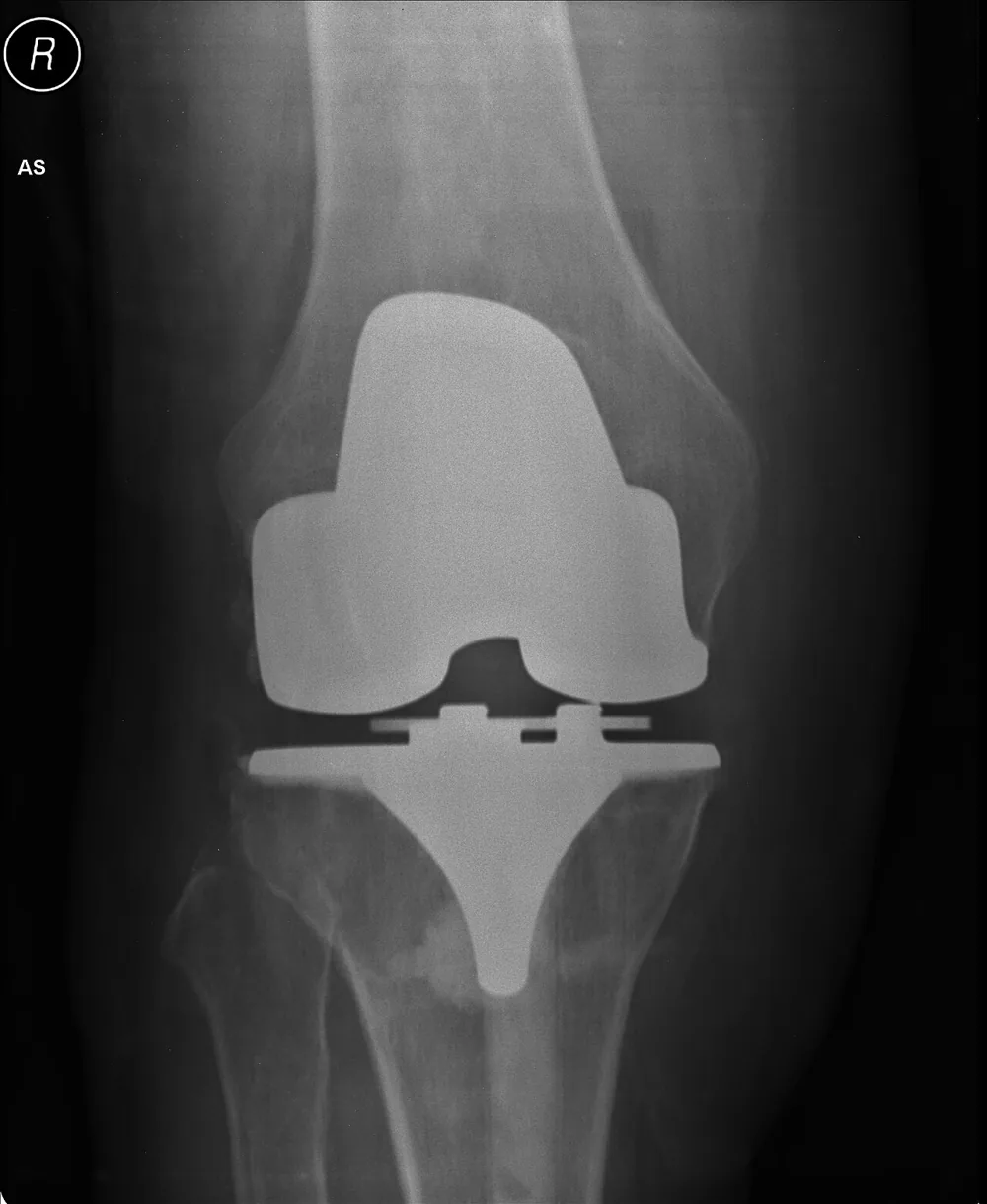 Radiografía de una prótesis total de rodilla