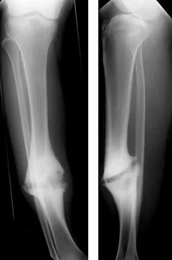 Radiografía de una pseudoartrosis o falta de unión ósea