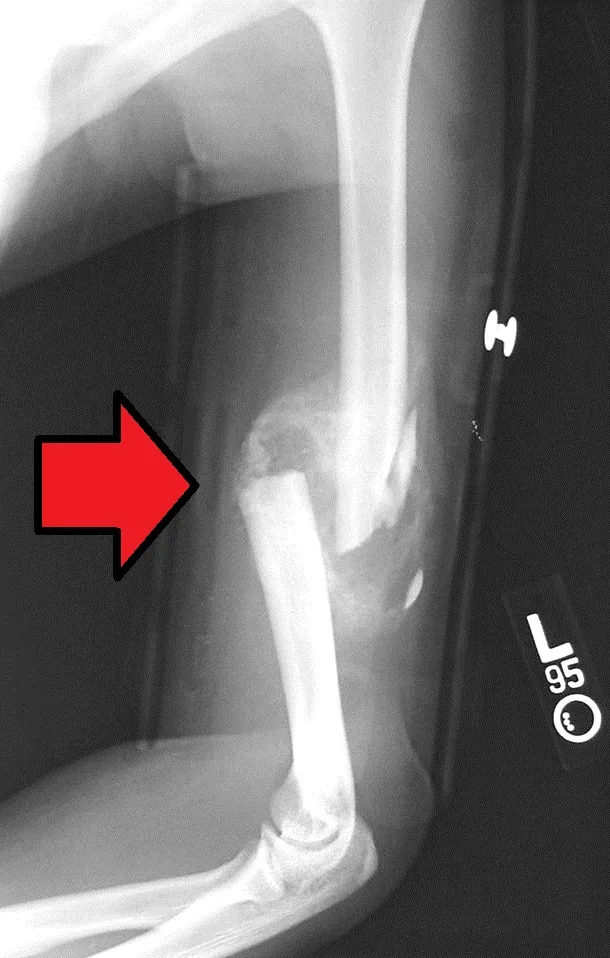 Radiografía de una fractura con retardo de consolidación