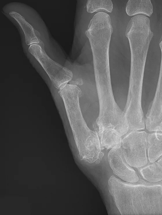 Magnetoterapia para la rizartrosis (artrosis del pulgar)