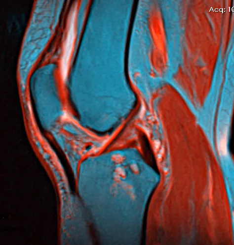 Resonancia magnética de la rodilla
