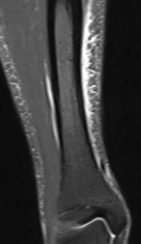 Magnetoterapia para la periostitis tibial
