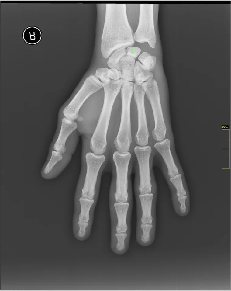Radiografía de mano derecha con el hueso semilunar señalado en el centro del carpo